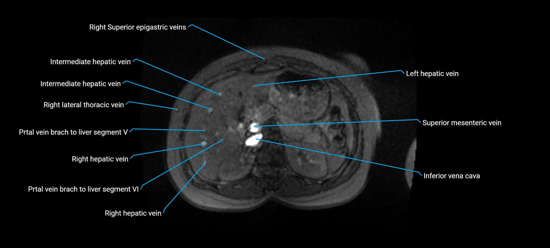 MRV abdomen pelvis & lower limb axial cross sectional anatomy labelled MRI image 50 (1).webp